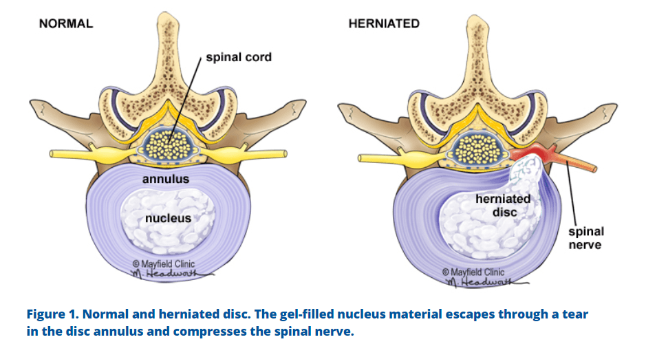 Herniated-Disc-vs-Normal-Disc-77 | EssentialOilsForTherapy.com